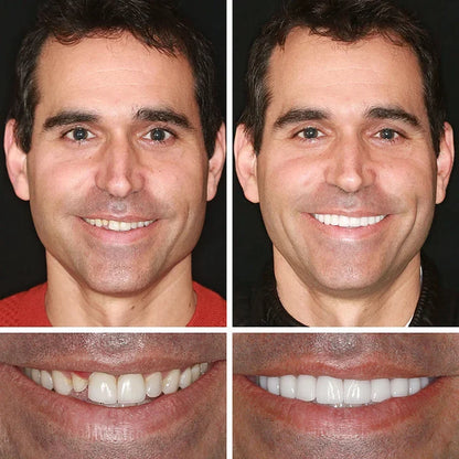 Medical Full Denture with Strong Suctiond🦷